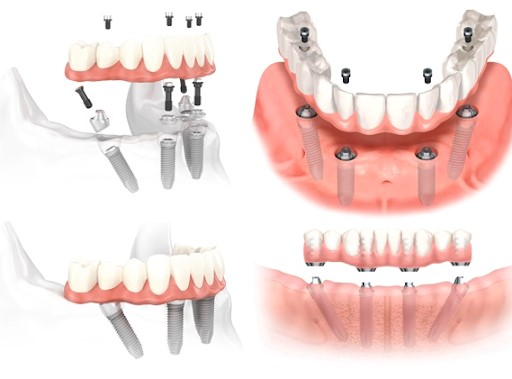 Giải pháp phục hình răng implant all in 4: ưu và nhược điểm 4