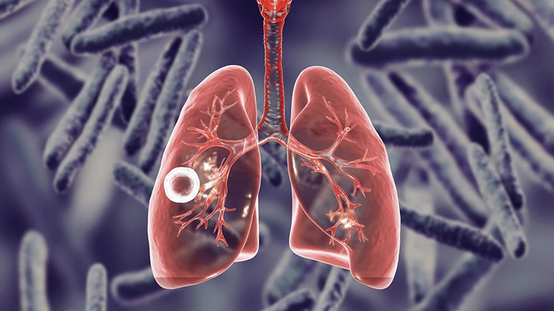 goc-giai-dap-hut-dich-mang-phoi-mat-bao-lau 3