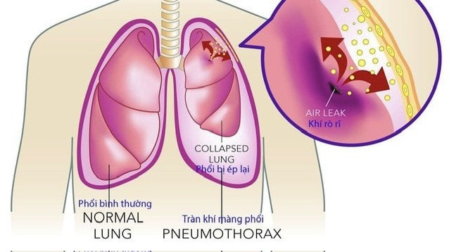 goc-giai-dap-hut-dich-mang-phoi-mat-bao-lau 1