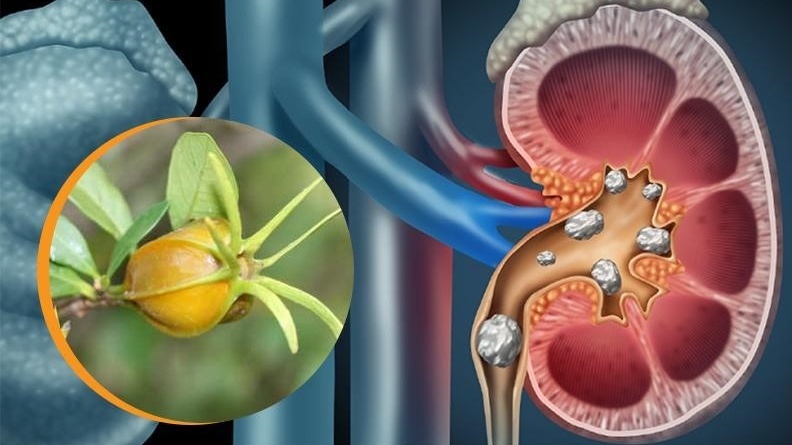 Góc giải đáp: Viêm cầu thận mạn sống được bao lâu? 1