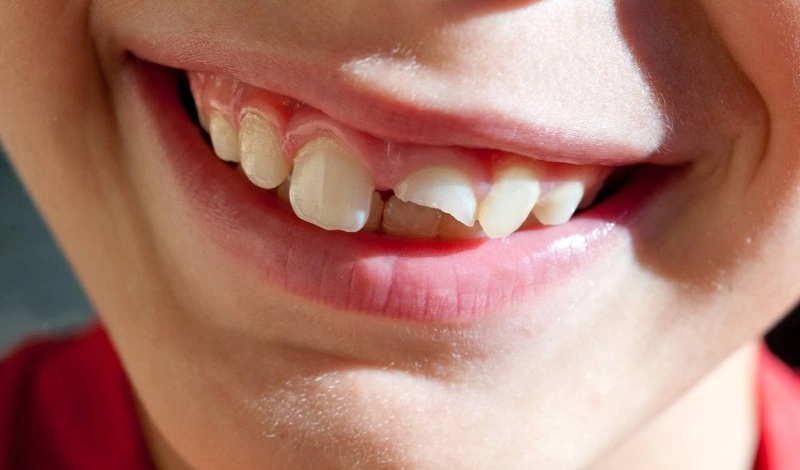 Gợi ý cách phục hồi răng bị mẻ tại nhà nhanh chóng 2