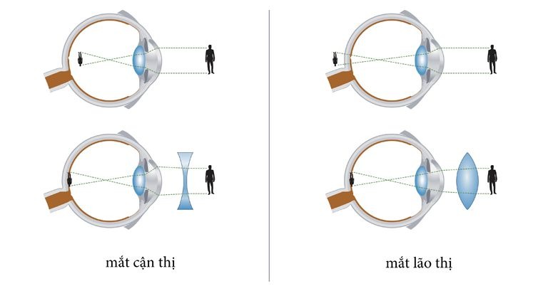 Gợi ý giúp bạn phân biệt cận thị và lão thị