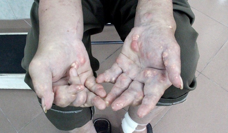 Gout cấp tính là gì? Những vấn đề cần biết về gout cấp tính 4