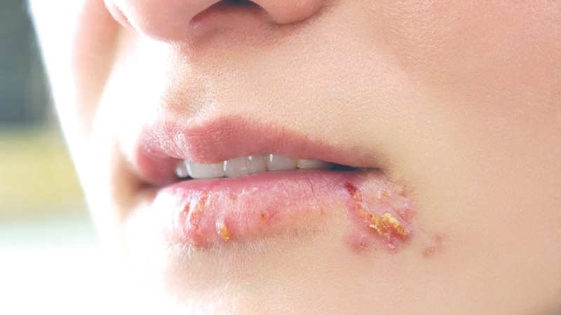 Hạch viêm quá sản là gì? Triệu chứng nhận biết và phương pháp điều trị ra sao? 2