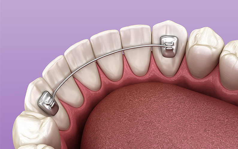 Hàm duy trì cố định mặt trong là gì? Có cấu tạo như thế nào? 3