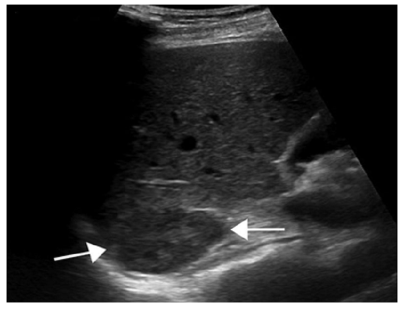 Hemangioma gan: Nguyên nhân, triệu chứng và cách điều trị 3