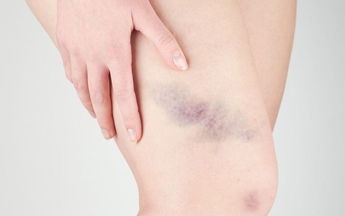 Hemophilia B là bệnh gì? Nguyên nhân và biểu hiện bệnh 3