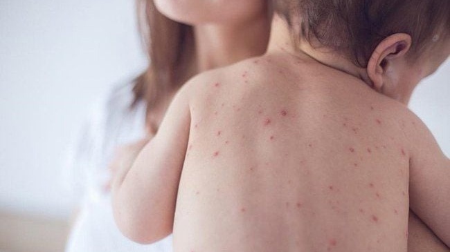 Hình ảnh bệnh sởi ở trẻ em: Phân biệt​ qua từng giai đoạn 4