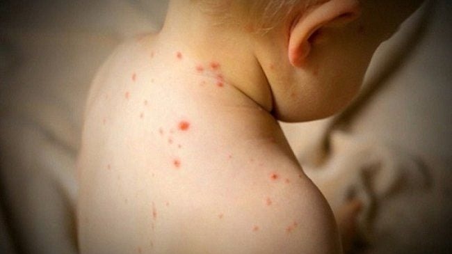 Hình ảnh bệnh sởi ở trẻ em: Phân biệt​ qua từng giai đoạn 2