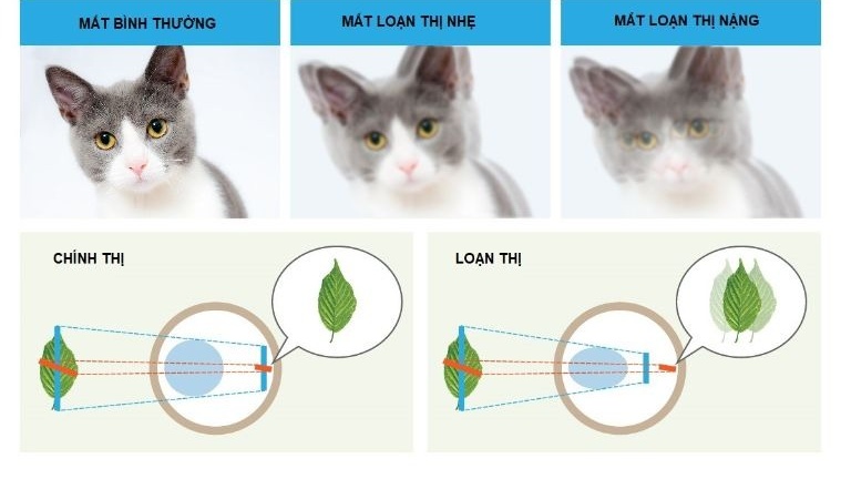 Hình ảnh người loạn thị nhìn thấy trong từng trường hợp