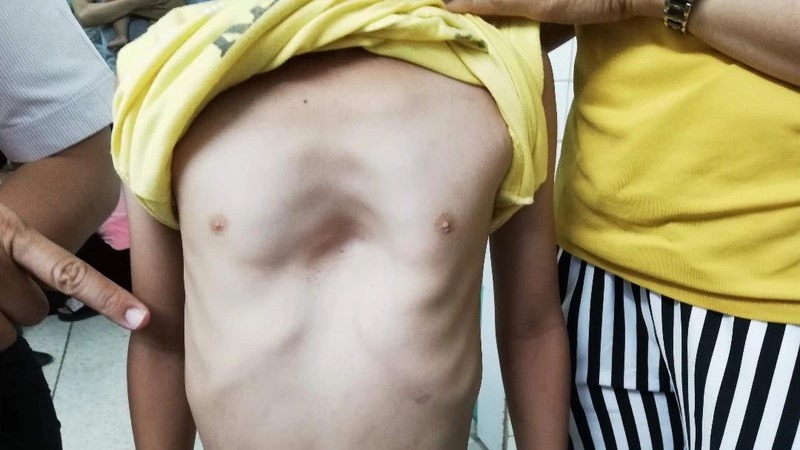 Hình ảnh trẻ em bị còi xương cảnh báo căn bệnh nguy hiểm 2