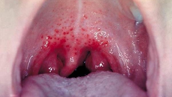 Hình ảnh viêm họng hạt: Nhận diện và phân biệt các triệu chứng hiệu quả 2