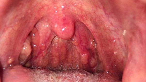 Hình ảnh viêm họng hạt: Nhận diện và phân biệt các triệu chứng hiệu quả 3