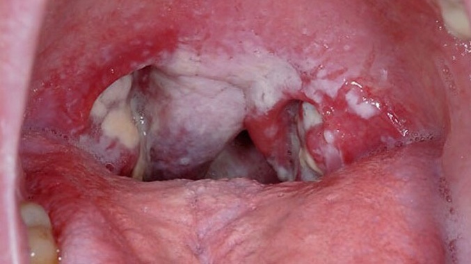 Hình ảnh viêm họng hạt: Nhận diện và phân biệt các triệu chứng hiệu quả 5