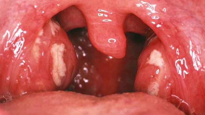 Hình ảnh viêm họng hạt: Nhận diện và phân biệt các triệu chứng hiệu quả 6