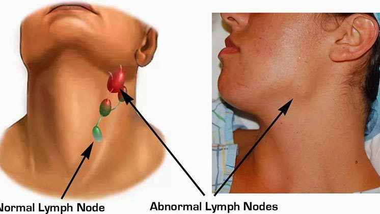HIV 1 và 2 là gì? Khác nhau thế nào? 3