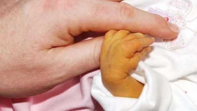 hoi-chung-alagille-la-gi-nhung-dieu-can-biet 2