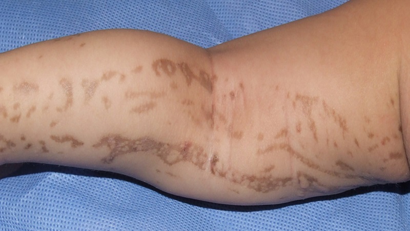 Hội chứng Bloch-Sulzberger: Triệu chứng, nguyên nhân và giải pháp 1