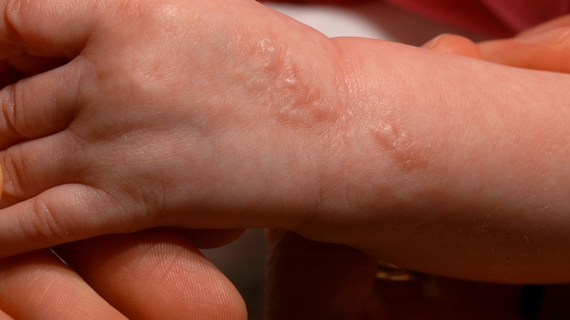 Hội chứng Bloch-Sulzberger: Triệu chứng, nguyên nhân và giải pháp 3