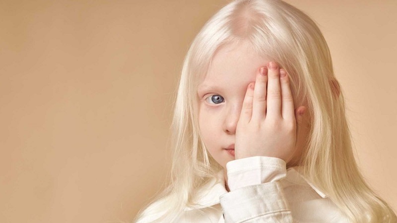 Hội chứng Chédiak-Higashi: Dấu hiệu, nguyên nhân và điều trị 1