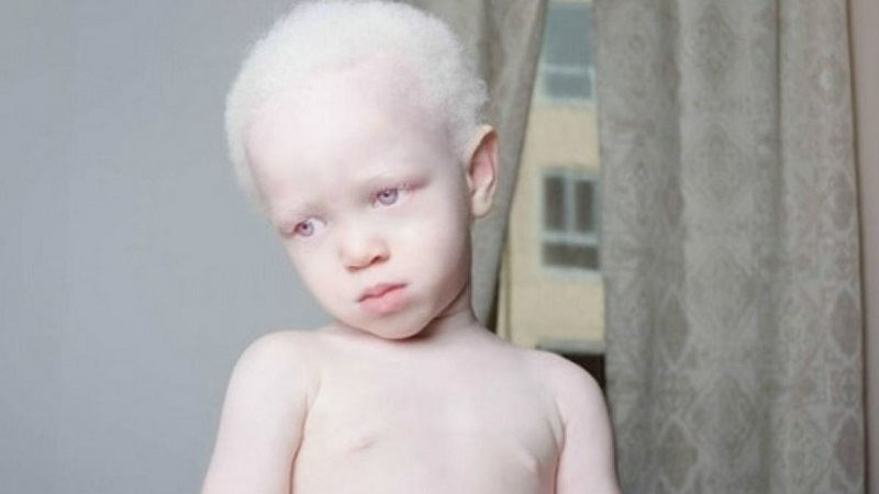 Hội chứng Chédiak-Higashi: Dấu hiệu, nguyên nhân và điều trị 2