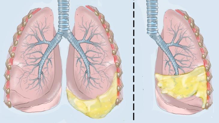 Hội chứng demons meigs là gì? Những vấn đề cần biết về Hội chứng demons meigs 1.jpg