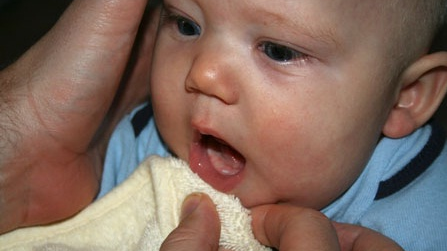 Tứ chứng Fallot (Fallot 4): Nguyên nhân và cách điều trị 3