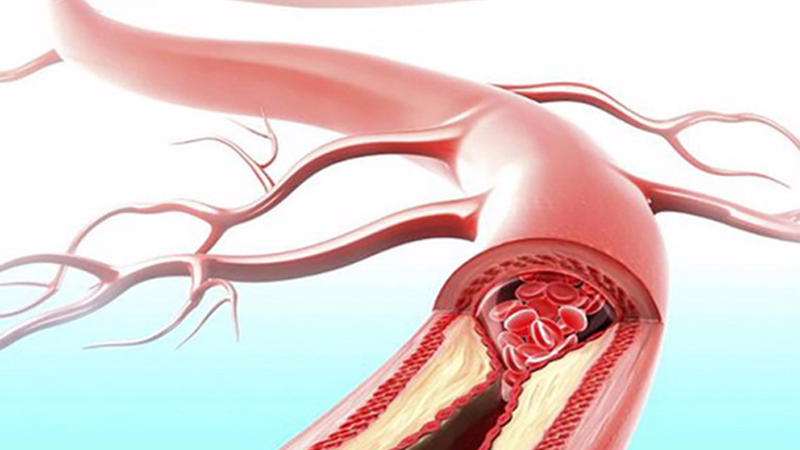 Hội chứng gan phổi và những thông tin bạn cần biết 1