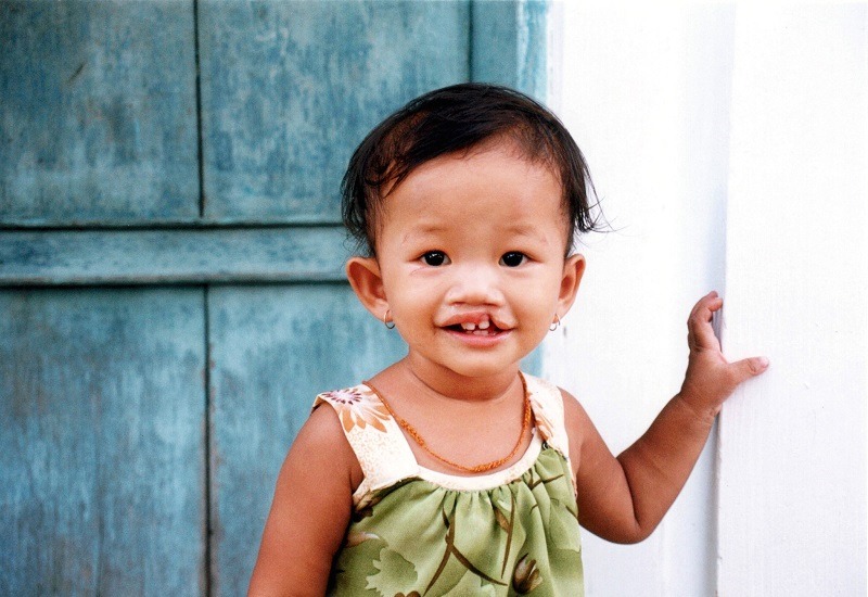 hoi-chung-kallmann-di-truyen-bam-sinh-la-gi 2.jpg