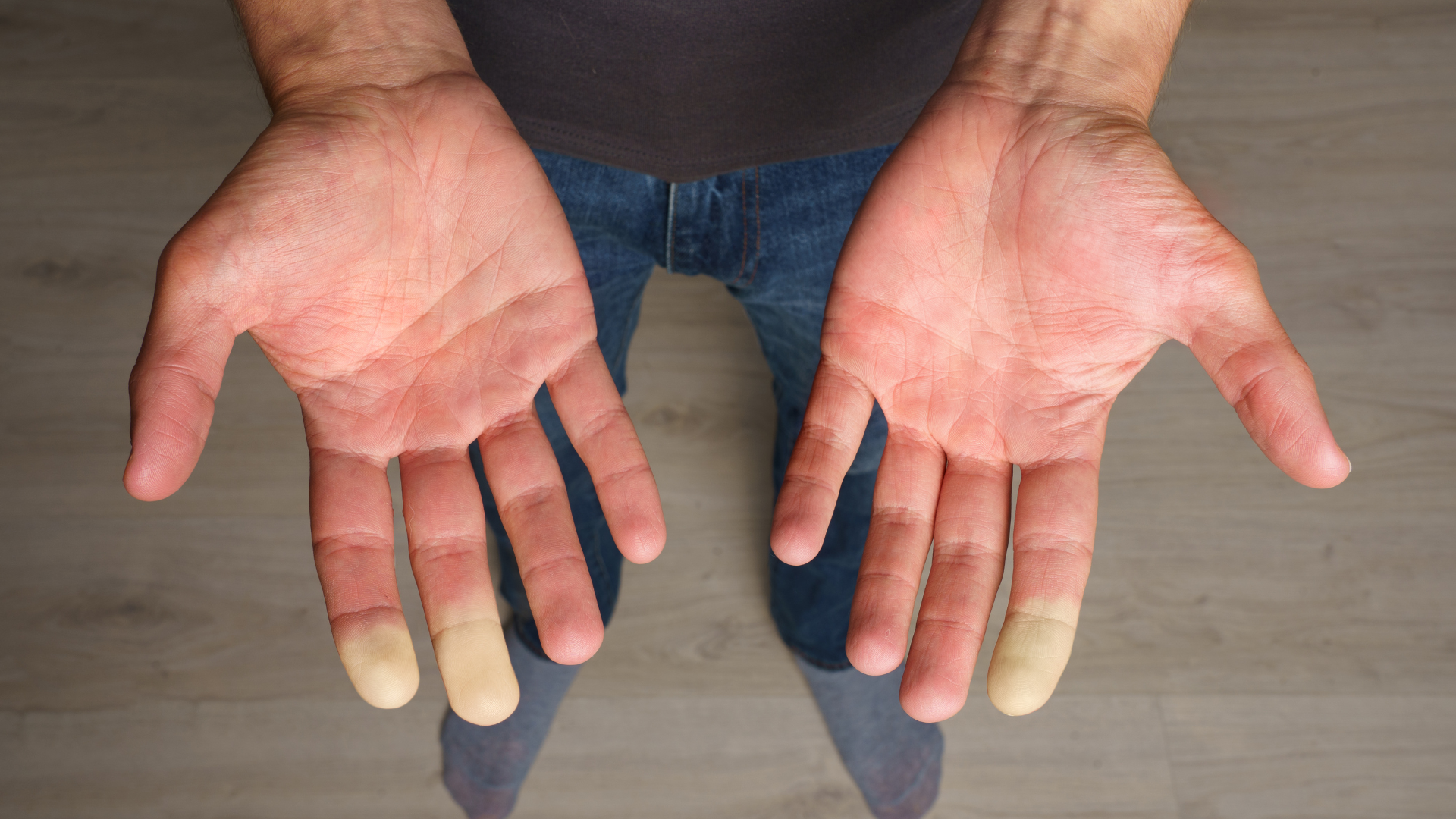 Hội chứng Raynaud: Triệu chứng, nguyên nhân và điều trị