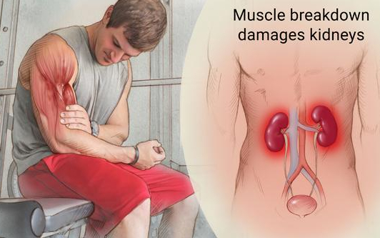 Những điều cần biết về hội chứng tiêu cơ vân cấp 3