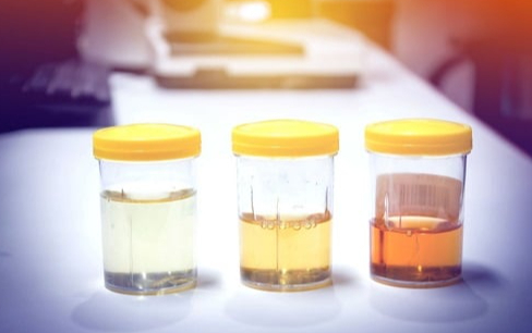 Những điều cần biết về hội chứng tiêu cơ vân cấp 4