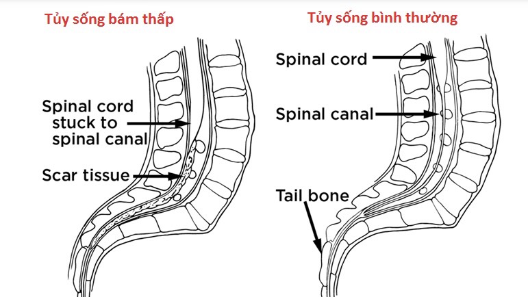 hoi-chung-tuy-song-bam-thap-ke-tham-lang-de-doa-suc-khoe-cot-song 1