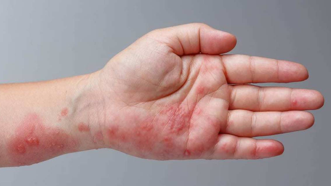 Góc hỏi đáp: Bị giời leo (zona thần kinh) có lây không? 1