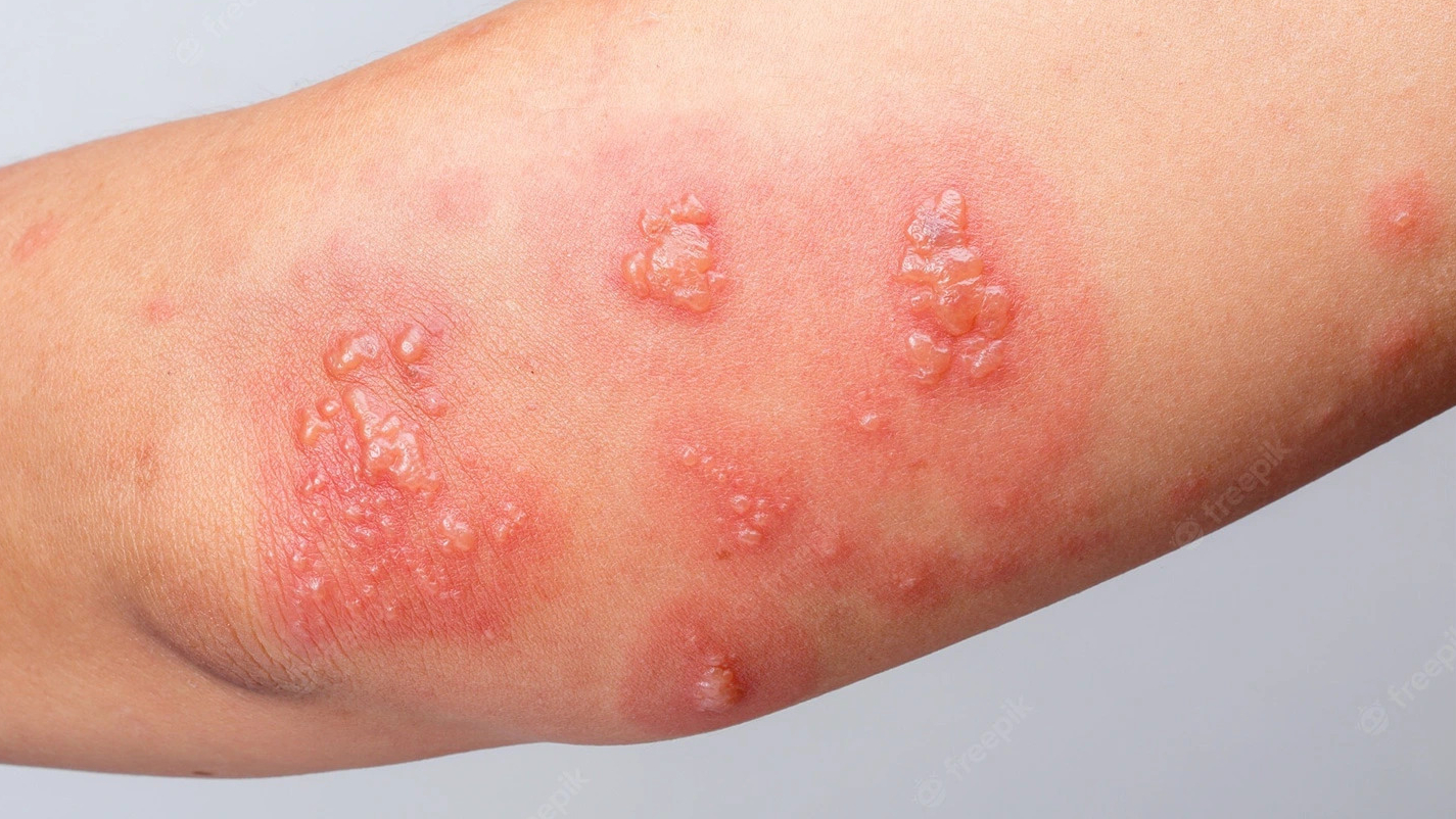 Góc hỏi đáp: Bị giời leo (zona thần kinh) có lây không? 2