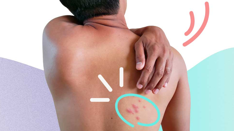 Góc hỏi đáp: Bị giời leo (zona thần kinh) có lây không? 3