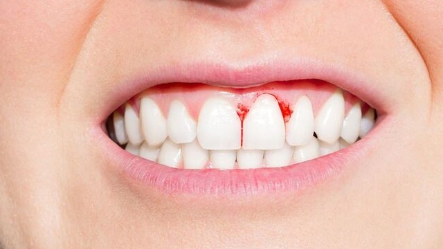 hôi miệng do viêm lợi khắc phục như thế nào 2