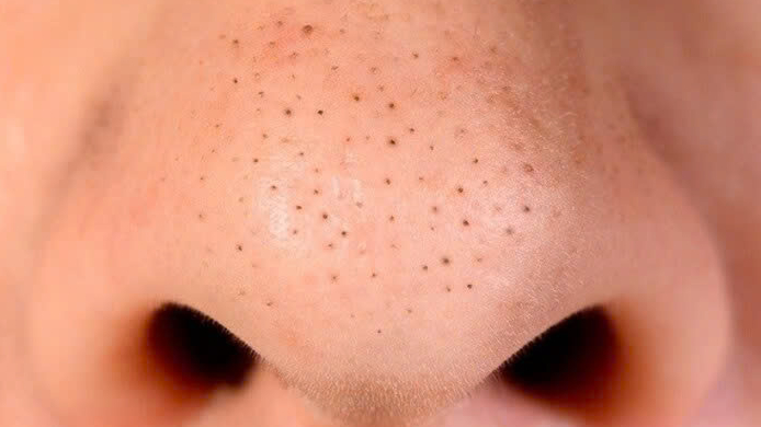 huong-dan-ban-cach-tri-mun-dau-den-bang-nha-dam 1.jpg