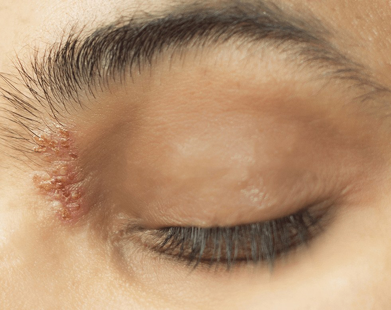 Hướng dẫn các loại thuốc bôi zona thần kinh giúp bệnh nhanh khỏi 1