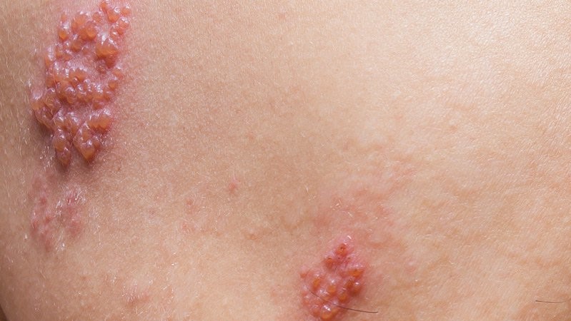 Hướng dẫn các loại thuốc bôi zona thần kinh giúp bệnh nhanh khỏi 7