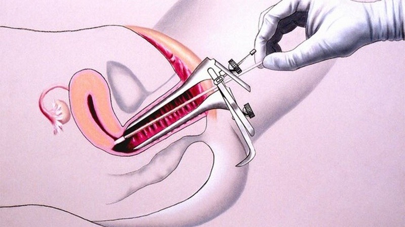 Hướng dẫn cách đọc kết quả sinh thiết cổ tử cung chính xác 3