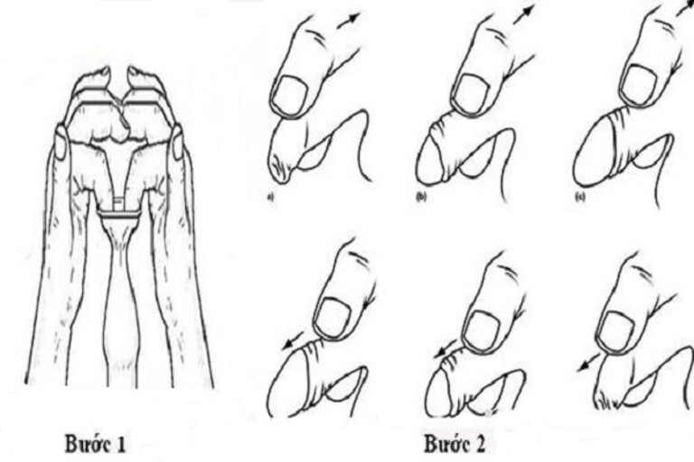 Hướng dẫn cách nong bao quy đầu an toàn và hiệu quả không phải ai cũng biết 4