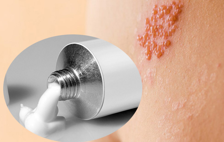 Hướng dẫn cách phân biệt zona thần kinh và kiến ba khoang 5