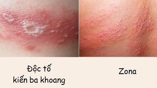 Hướng dẫn cách phân biệt zona thần kinh và kiến ba khoang 6