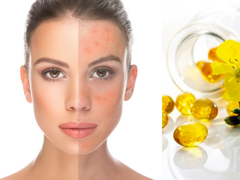 Hướng dẫn chi tiết cách bôi tinh dầu hoa anh thảo lên mặt đơn giản, hiệu quả 3