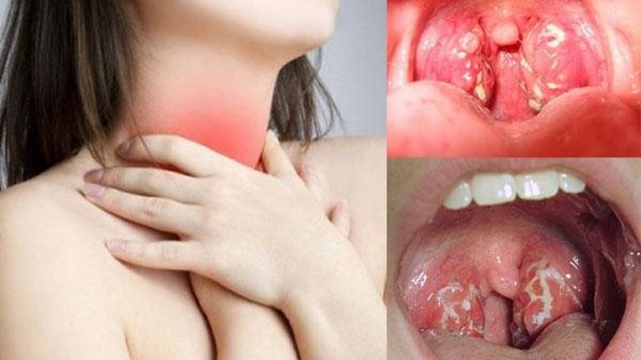 Viêm họng, viêm mũi và cảm lạnh là bệnh phổ biến khi thời tiết giao mùa