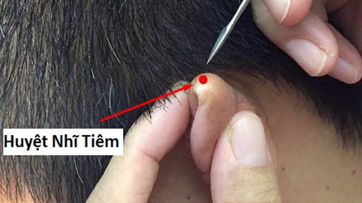 huyet-nhi-tiem-va-cach-cham-cuu-de-tri-chap-leo-mat 1.jpg