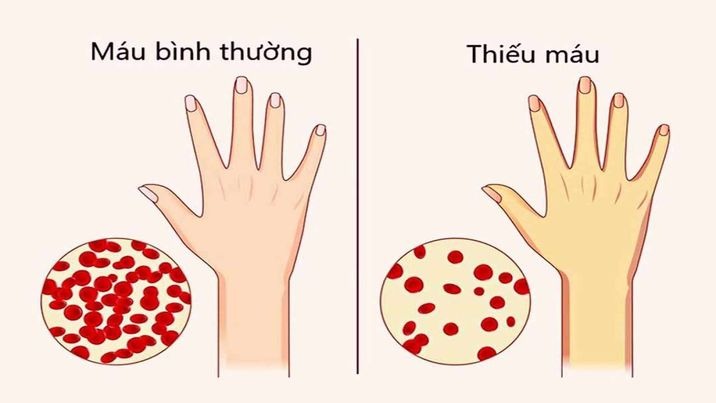 Huyết sắc tố thấp là gì? 3