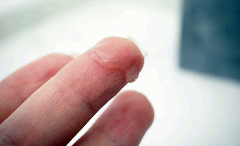 huyết trắng ra mỗi ngày có phải là dấu hiệu cảnh báo bệnh phụ khoa 1