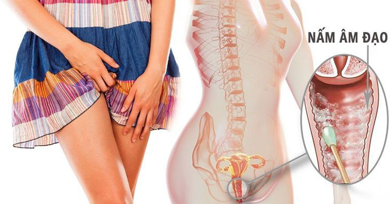 huyết trắng ra mỗi ngày có phải là dấu hiệu cảnh báo bệnh phụ khoa 3